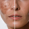 Cosmética Coreana Premium > Hiperpigmentación y manchas