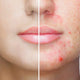 Cosmética Coreana Premium > Acné e imperfecciones